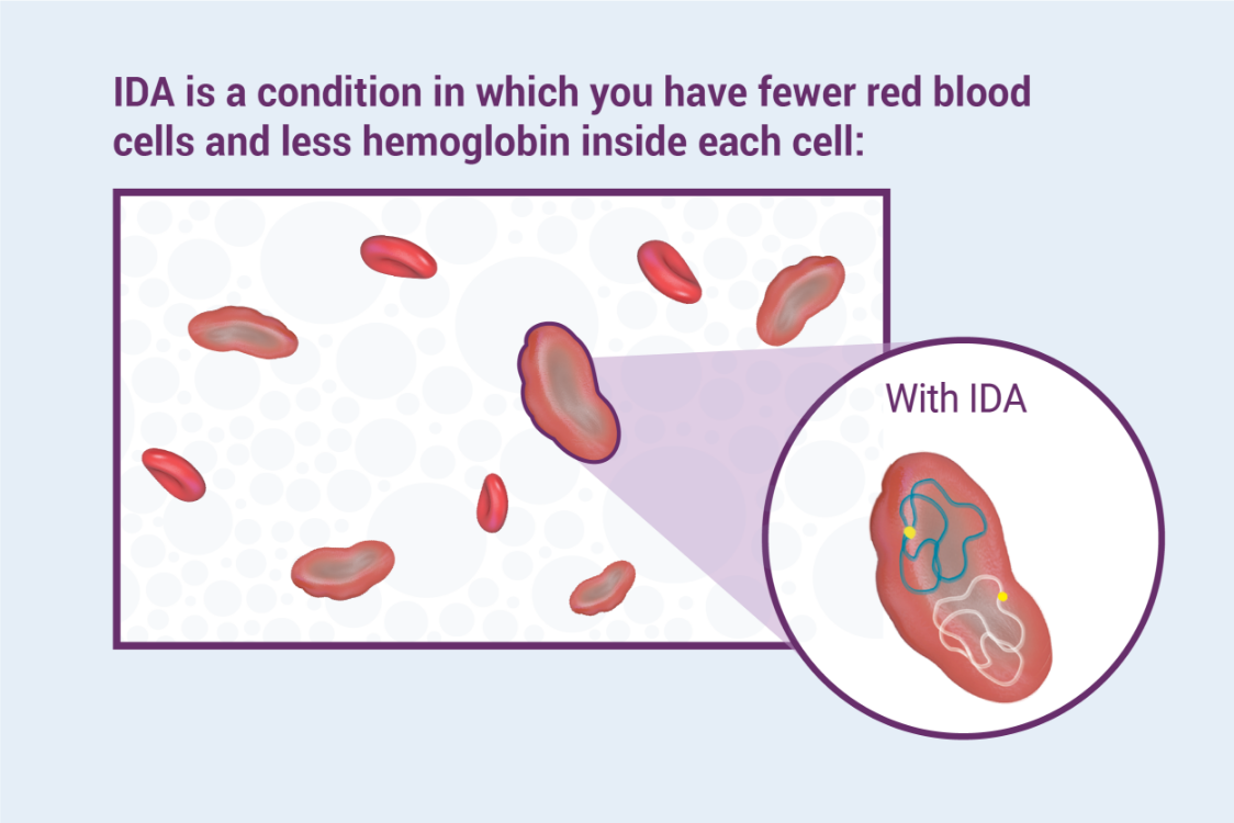 What Is Iron Deficiency Anemia (IDA)?